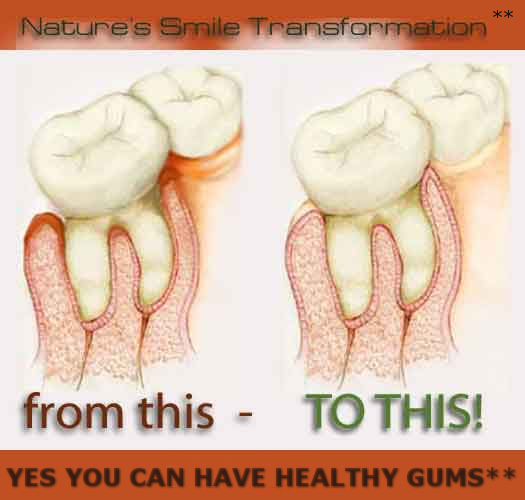 Regrow receding gums