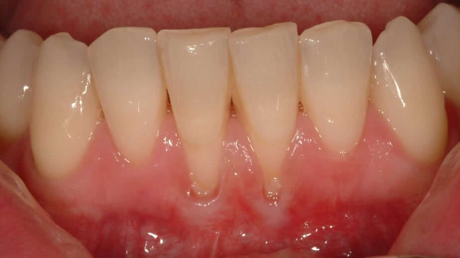 Understanding Gum Recession